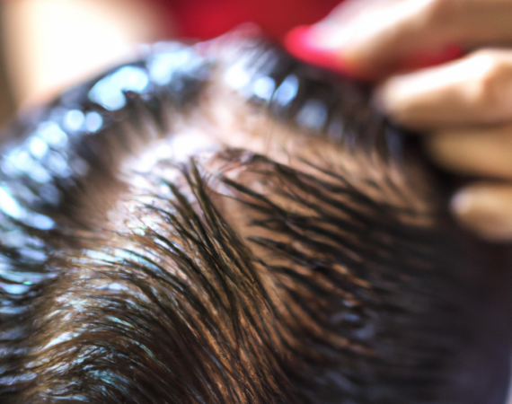 Female hair loss treatment